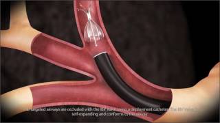 Endobronchial Valve Animation  SPIRATION [upl. by Einned118]