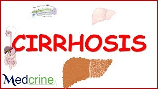 LIVER CIRRHOSIS causespathophysiologyfeaturesdiagnosistreatment [upl. by Bergen]