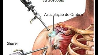 Cirugia no ombro explicações e informações [upl. by Leachim]