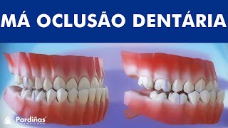 Má oclusão dentária  Classificação das maloclusões © [upl. by Gile]