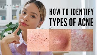 How to treat EVERY type of acne With Pictures [upl. by Amalbena102]