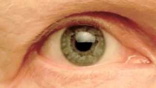 My Right Pupil Exhibiting Hippus  Pupillary Athetosis [upl. by Schulze]