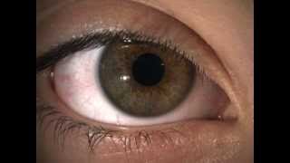 Hippus pupil fluctuation in a normal healthy eye [upl. by Jenifer]